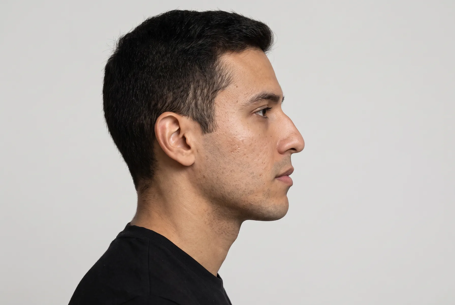 Homem de 28 anos de perfil estrito, cabelo curto, com uma pequena elevação natural no dorso do nariz