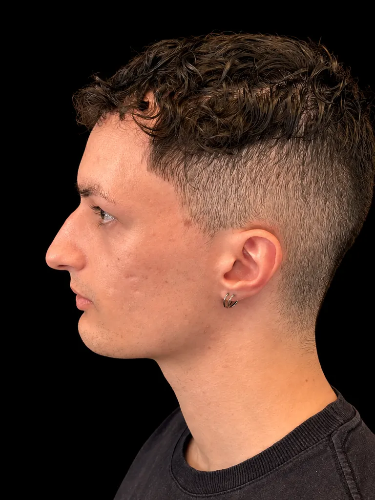 Rinoplastia em Curitiba, caso 1: perfil de homem jovem de cabelo escuro cacheado antes da cirurgia do nariz