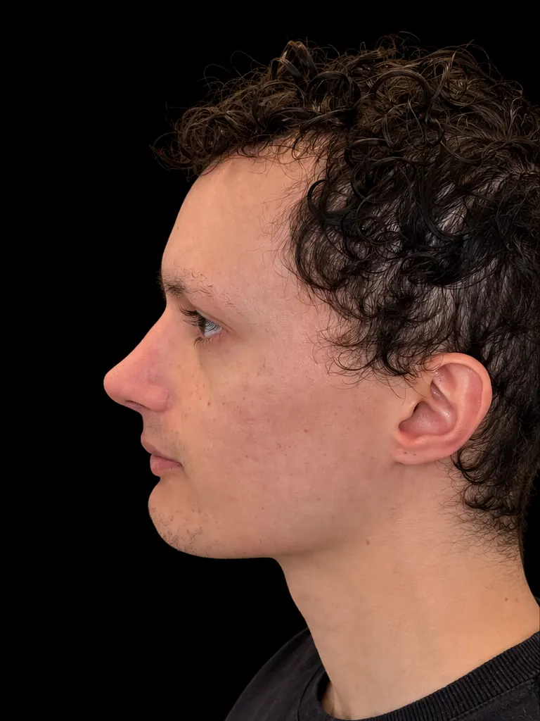 Rinoplastia em Curitiba, caso 1: perfil do mesmo homem jovem de cabelo cacheado depois da cirurgia do nariz