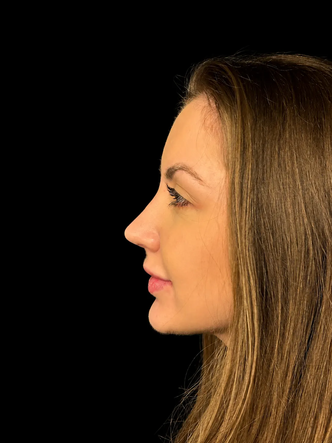 Rinoplastia em Curitiba, caso 3: perfil da mesma mulher, de cabelo castanho com mechas, depois da cirurgia do nariz