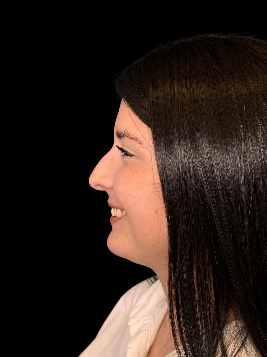 Rinoplastia em Curitiba, caso 4: perfil de mulher de cabelo preto liso, sorrindo, antes da cirurgia do nariz