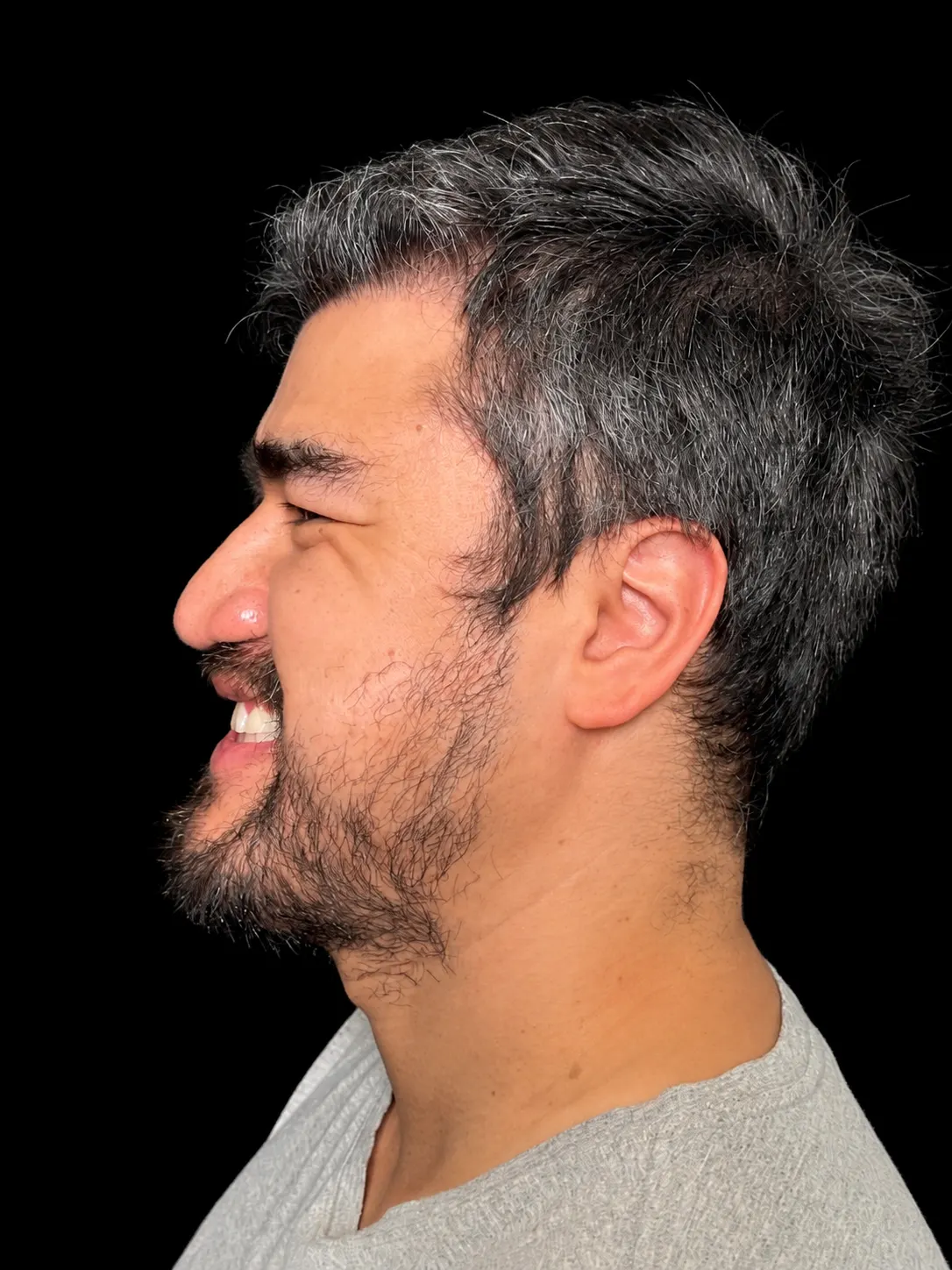 Rinoplastia em Curitiba, caso 5: perfil de homem de cabelo grisalho e barba, sorrindo, antes da cirurgia do nariz