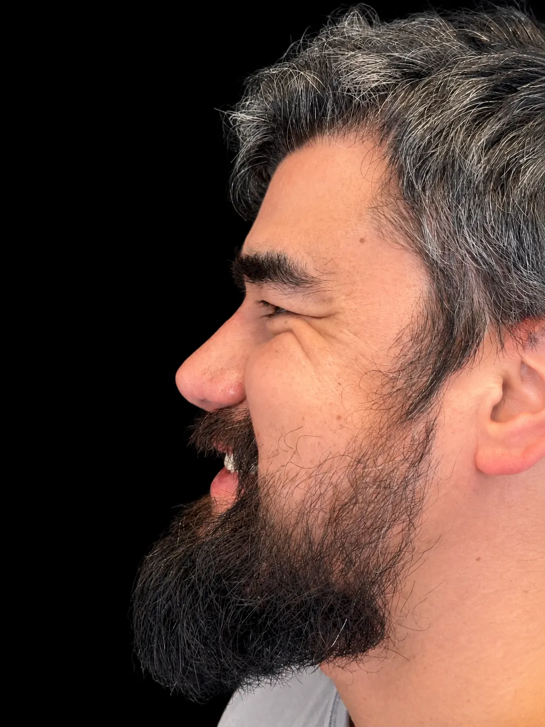 Rinoplastia em Curitiba, caso 5: perfil do mesmo homem de cabelo grisalho e barba cheia, sorrindo, depois da cirurgia do nariz