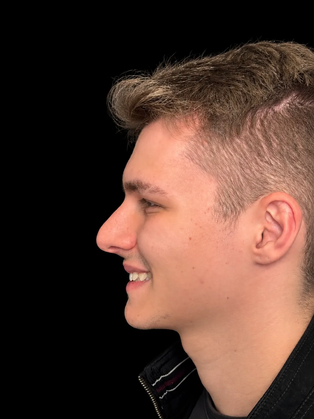 Rinoplastia em Curitiba, caso 6: perfil de homem jovem de cabelo castanho claro, sorrindo, antes da cirurgia do nariz