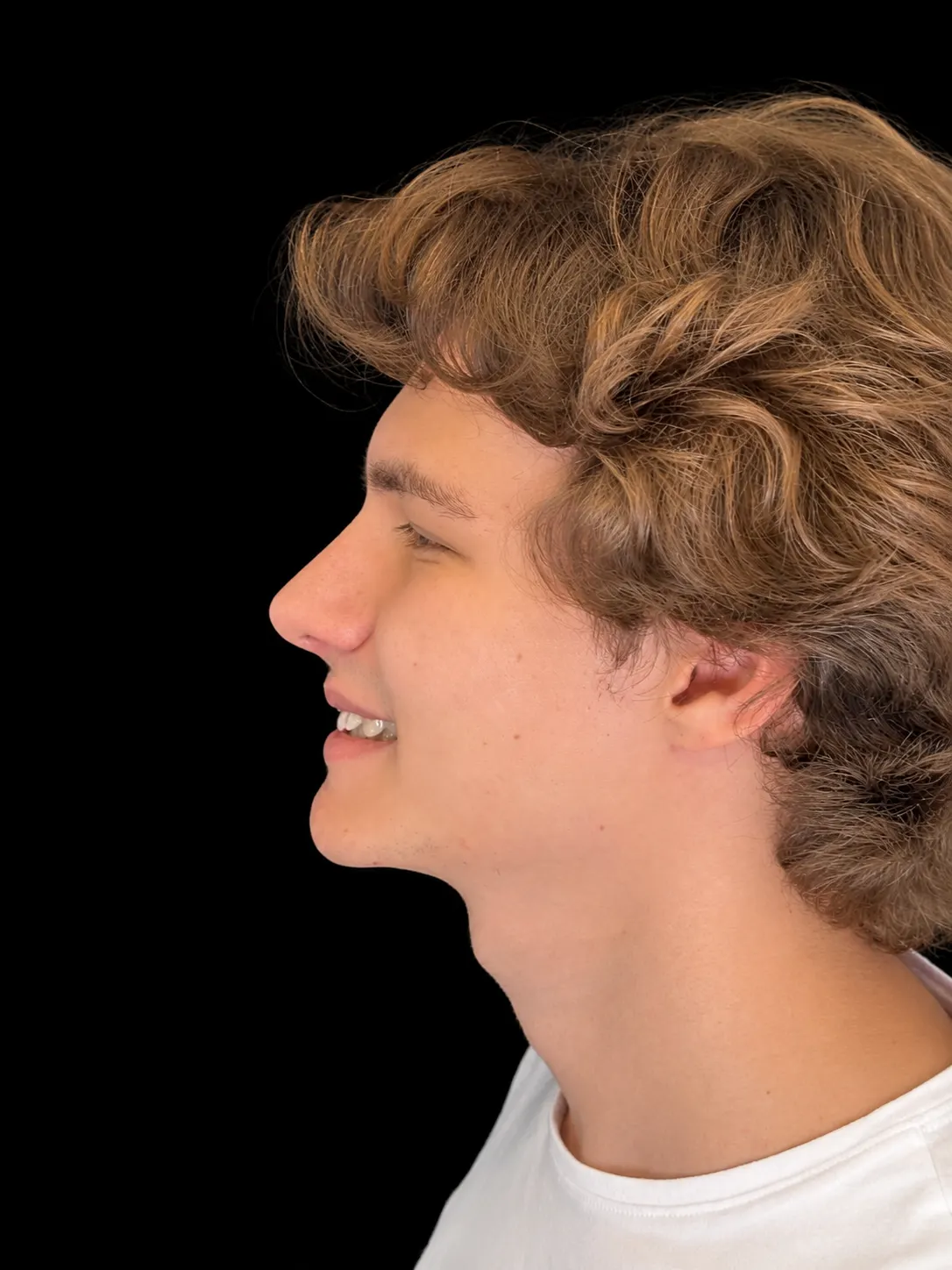 Rinoplastia em Curitiba, caso 6: perfil do mesmo homem jovem, de cabelo ondulado, sorrindo, depois da cirurgia do nariz